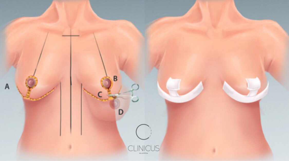 Krūtinės mažinimas operacija