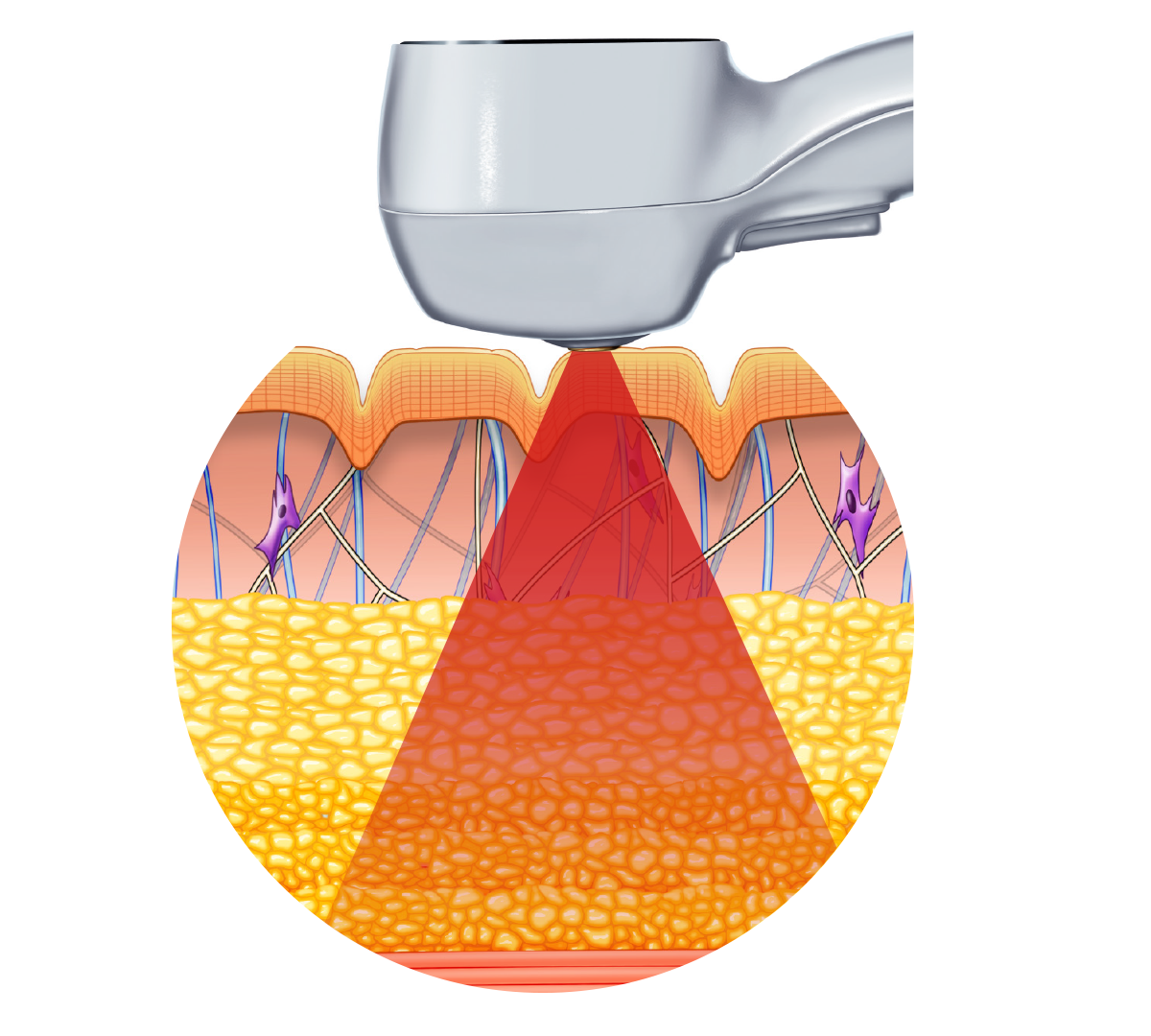 Exilis_Ultra_360_PIC_Moa-fat-big-app_EN100 (1)