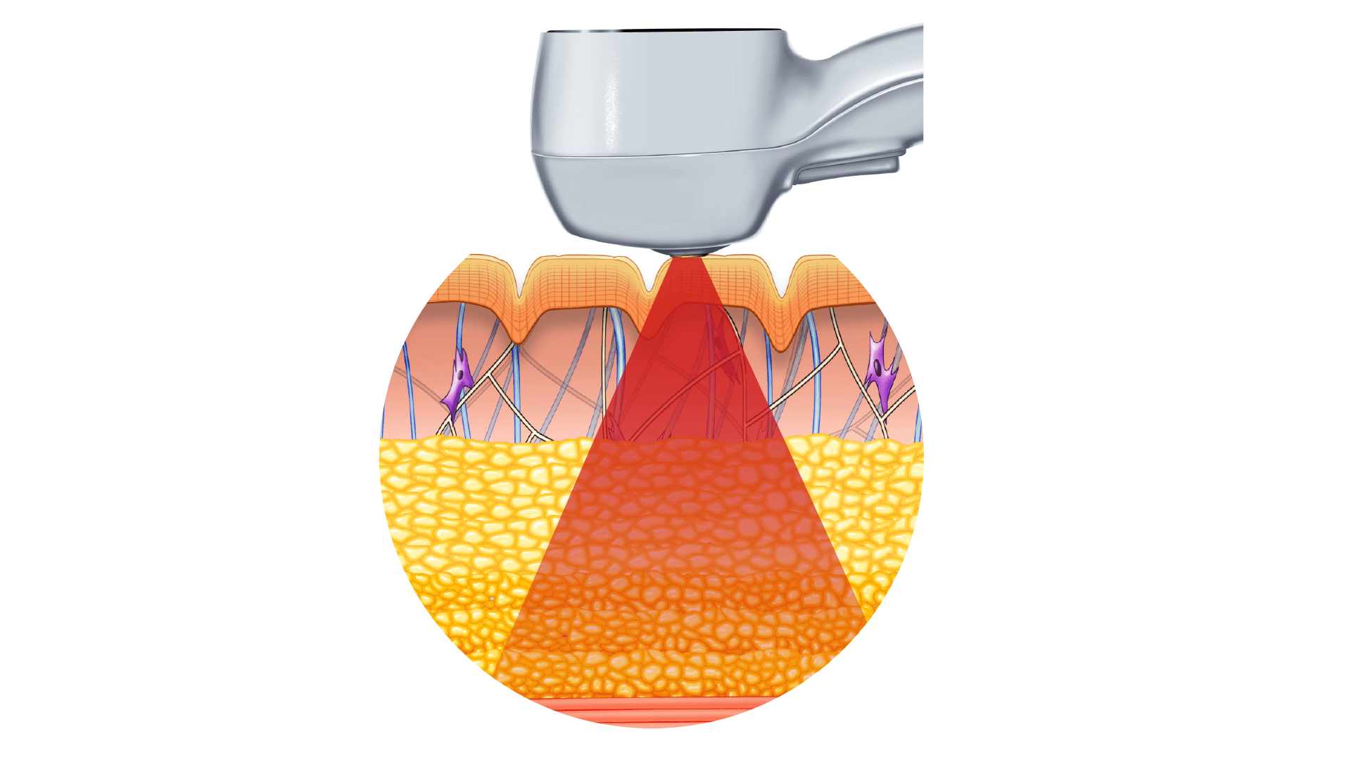 Exilis_Ultra_360_PIC_Moa-fat-big-app_EN100 (1) - CLINICUS