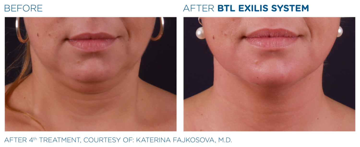 small BTL_Exilis_system_PIC_Ba-card-female-face-025_EN100 - CLINICUS