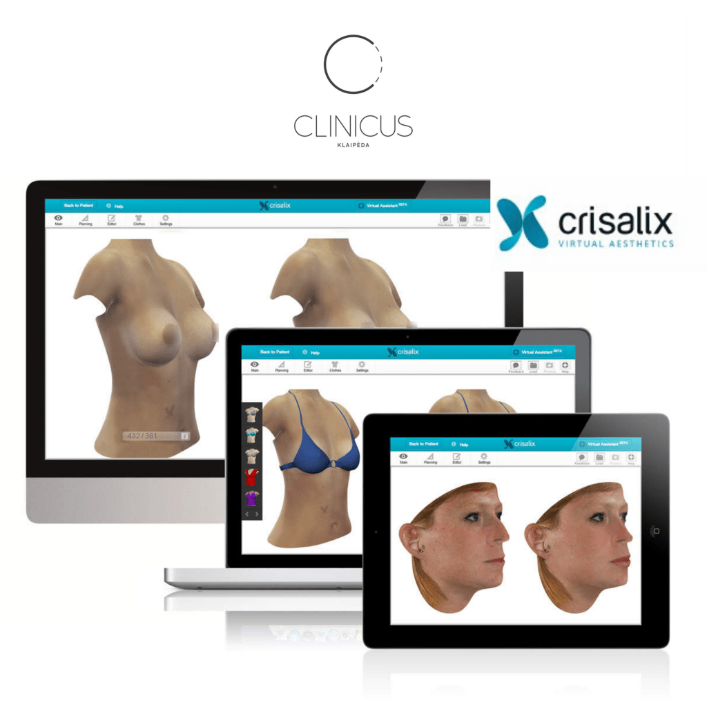 kaip atrodys krūtinė po operacijos - demonstruoja virtualus Crisalix modeliavimas
