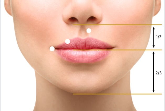 lūpos korekcija lip lift