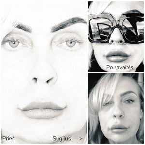 Lip Lift pjūviai ties nosies šnervėmis