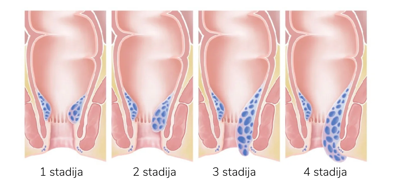 hemorojaus gydymas operacija
