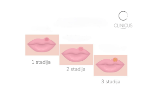 herpes virusas