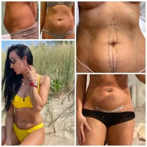 abdominoplastinė operacija su riebalų nusiurbimu