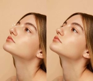 Rhinoplasty in Lithuania