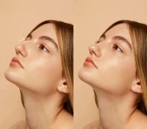 Rhinoplasty in Lithuania