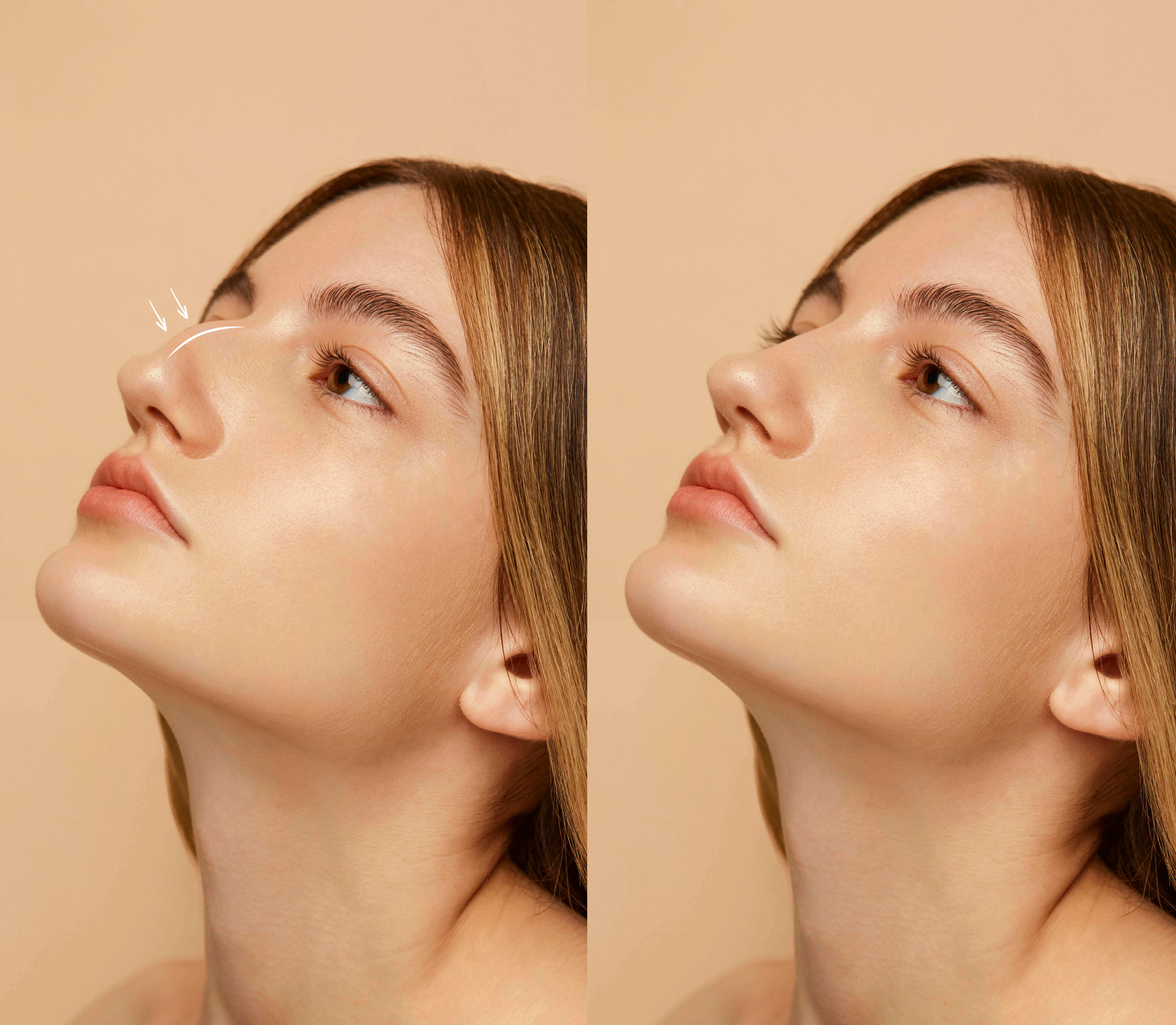Rhinoplasty in Lithuania
