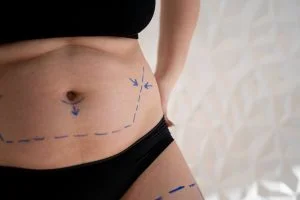 tummy tuck surgery