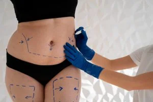 tummy tuch with liposuction