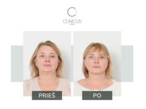 SMAS plikacijos technika